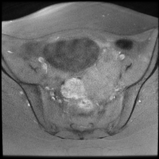 File:Bilateral ovarian fibrothecomas - adolescent (Radiopaedia 86604-102707 Axial T1 fat sat 12).jpg