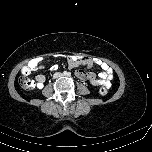 Bilateral ovarian serous cystadenocarcinoma (Radiopaedia 86062-101989 B 60).jpg