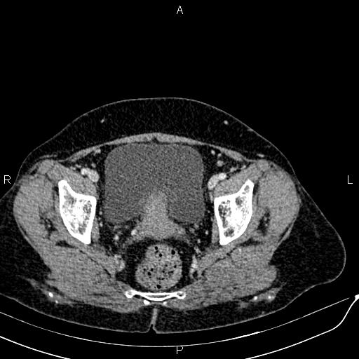 Bilateral ovarian serous cystadenocarcinoma (Radiopaedia 86062-101989 B 91).jpg