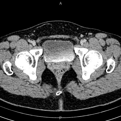 Bilateral ovarian teratoma (Radiopaedia 83131-97503 B 71).jpg