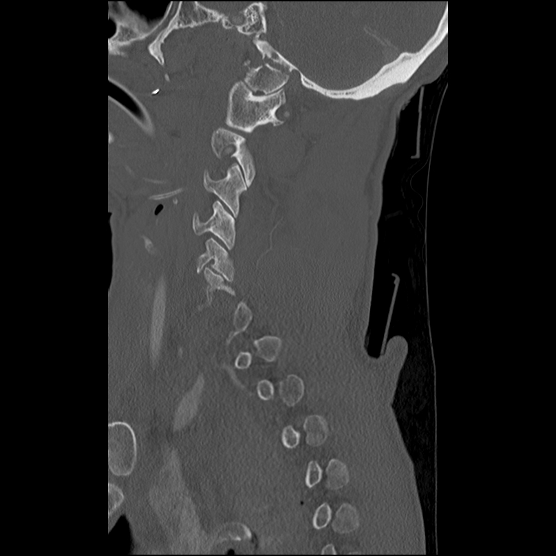 Bilateral perched facets with cord injury (Radiopaedia 45587-49713 Sagittal bone window 13).jpg
