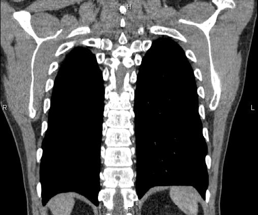 Bilateral pulmonary AVM (Radiopaedia 83134-97505 C 61).jpg