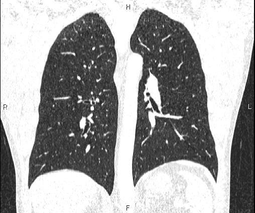 File:Bilateral pulmonary AVM (Radiopaedia 83134-97505 Coronal lung window 52).jpg