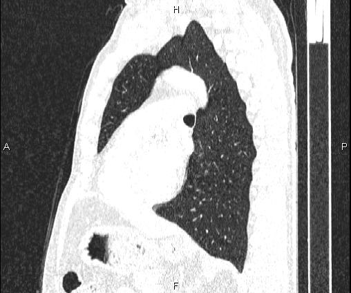 Bilateral pulmonary AVM (Radiopaedia 83134-97505 Sagittal lung window 70).jpg