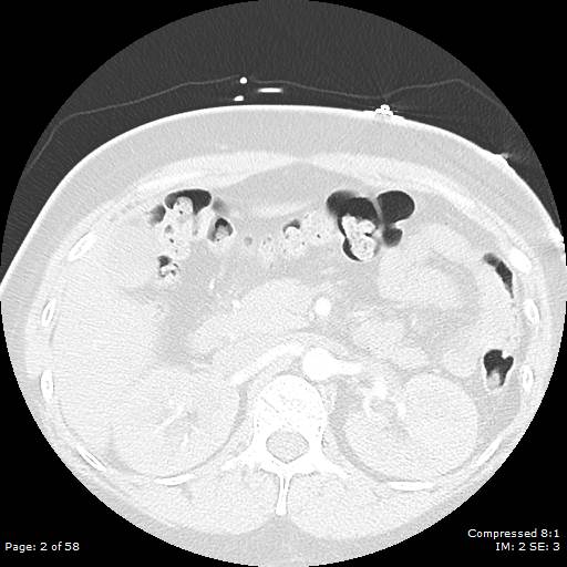 Bilateral pulmonary emboli with Hampton hump sign (Radiopaedia 54070-60246 Axial lung window 2).jpg