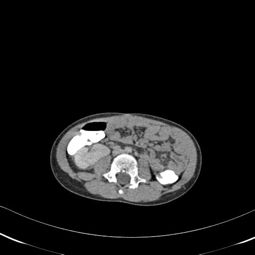 File:Bilateral renal malrotation (Radiopaedia 30901-31606 A 10).jpg