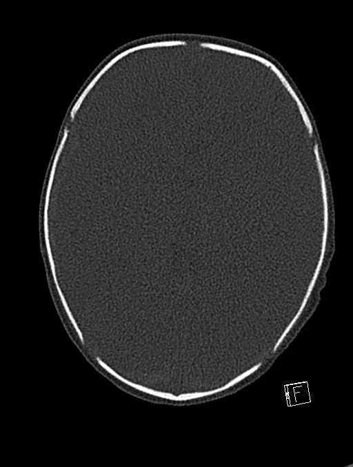 Bilateral subdural hemorrhage and parietal skull fracture (Radiopaedia 26058-26192 Axial bone window 67).png