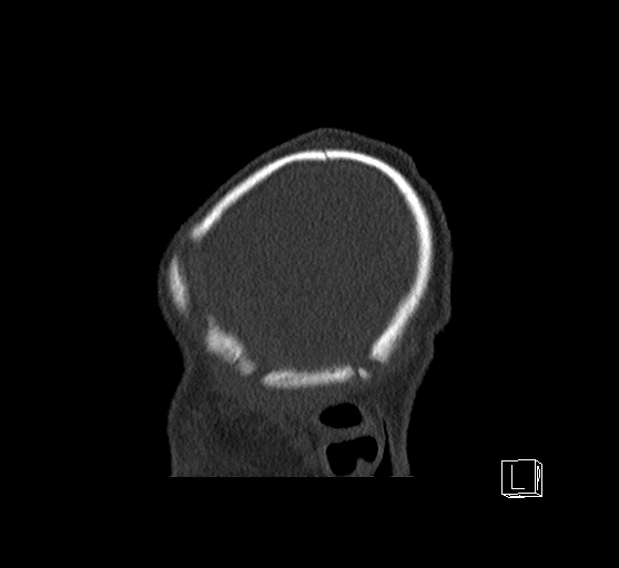 Bilateral subdural hemorrhage and parietal skull fracture (Radiopaedia 26058-26192 Sagittal bone window 89).png