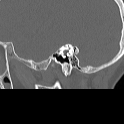 Bilateral tympanoplasty (Radiopaedia 16947-16664 Sagittal bone window 31).jpg