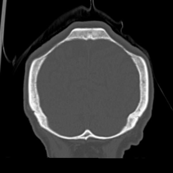Biparietal osteodystrophy (Radiopaedia 46109-50463 Coronal bone window 90).jpg