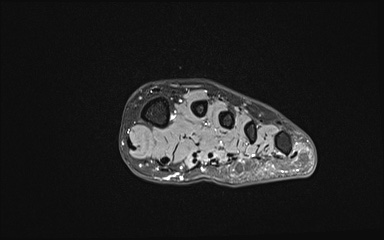 Bipartite hallux sesamoid diastasis (Radiopaedia 77133-89109 Coronal T2 fat sat 18).jpg