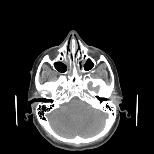 File:Bisphosphonate-related osteonecrosis of the jaw (Radiopaedia 71324-81642 non-contrast 159).jpg