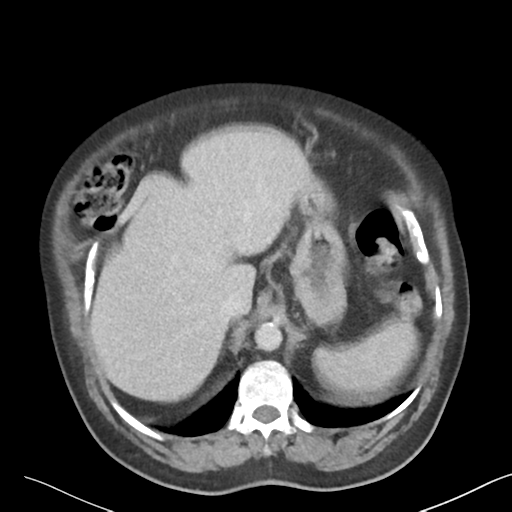 File:Bladder papillary urothelial carcinoma (Radiopaedia 48119-52951 Axial 8).png