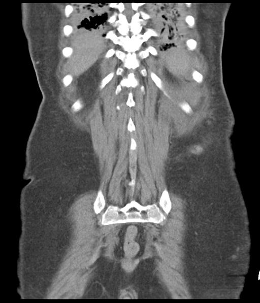Bladder rupture post renal biopsy (Radiopaedia 30863-31572 Coronal non-contrast 49).jpg
