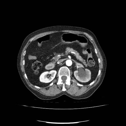 Bladder tumor detected on trauma CT (Radiopaedia 51809-57609 A 99).jpg