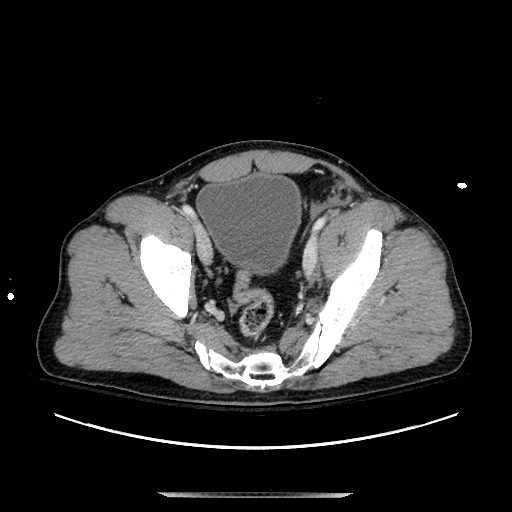 Blunt abdominal trauma with solid organ and musculoskelatal injury with active extravasation (Radiopaedia 68364-77895 A 133).jpg