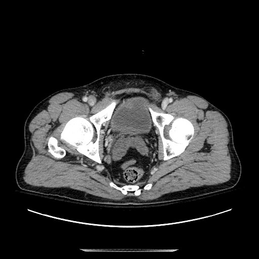 Blunt abdominal trauma with solid organ and musculoskelatal injury with active extravasation (Radiopaedia 68364-77895 A 147).jpg