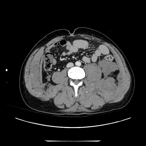 Blunt abdominal trauma with solid organ and musculoskelatal injury with active extravasation (Radiopaedia 68364-77895 A 87).jpg