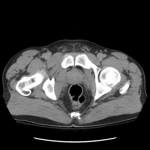 Blunt abdominal trauma with solid organ and musculoskelatal injury with active extravasation (Radiopaedia 68364-77895 Axial C+ delayed 135).jpg