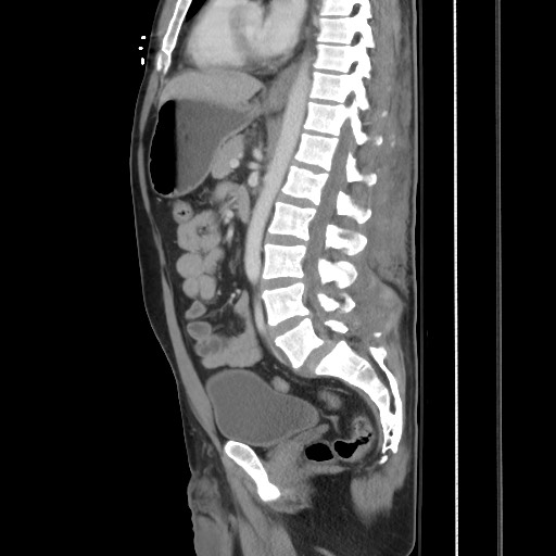 Blunt abdominal trauma with solid organ and musculoskelatal injury with active extravasation (Radiopaedia 68364-77895 C 80).jpg