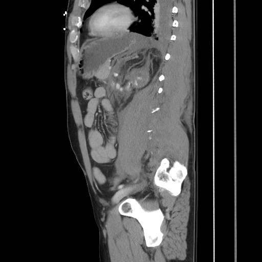 Blunt abdominal trauma with solid organ and musculoskelatal injury with active extravasation (Radiopaedia 68364-77895 C 95).jpg
