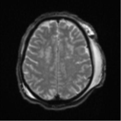 Blunt cerebrovascular injury (Radiopaedia 53682-59745 Axial DWI 22).png