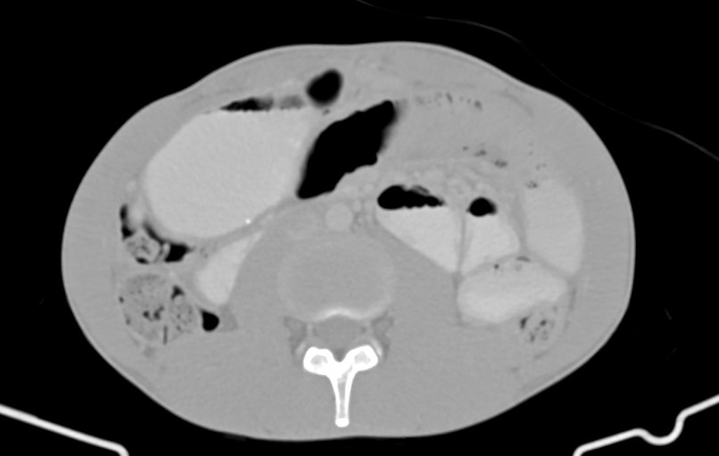 Blunt injury to the small bowel (Radiopaedia 74953-85987 Axial Wide 45).jpg