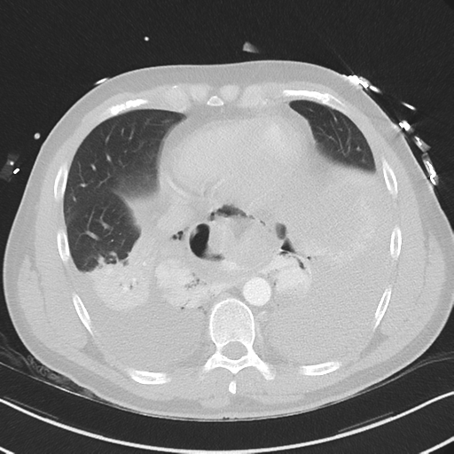 Boerhaave syndrome (Radiopaedia 39382-41661 Axial lung window 41).png