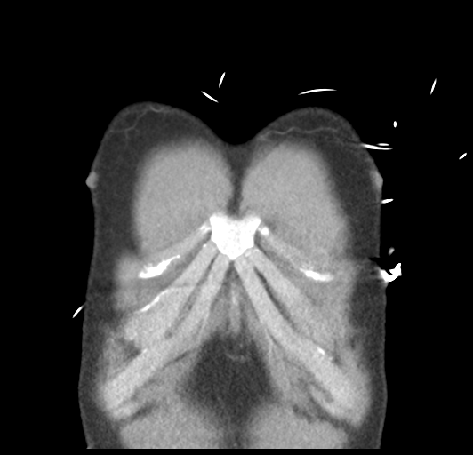 File:Boerhaave syndrome (Radiopaedia 39382-41661 B 7).png