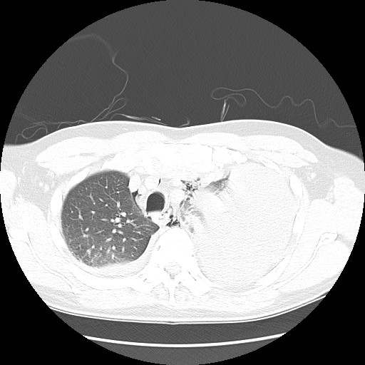 Boerhaave syndrome (Radiopaedia 59796-67310 Axial lung window 19).jpg