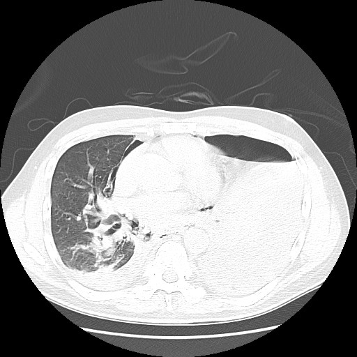 Boerhaave syndrome (Radiopaedia 59796-67310 Axial lung window 36).jpg