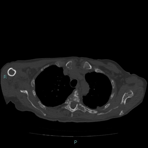 Bone metastases from untreated breast cancer (Radiopaedia 42973-46219 Axial bone window 27).jpg
