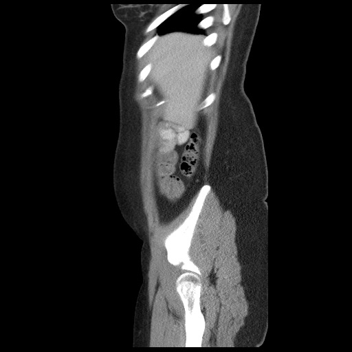 File:Borderline mucinous tumor (ovary) (Radiopaedia 78228-90808 B 14).jpg