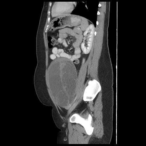 File:Borderline mucinous tumor (ovary) (Radiopaedia 78228-90808 B 45).jpg