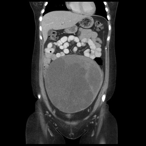 Borderline mucinous tumor (ovary) (Radiopaedia 78228-90808 C 18).jpg