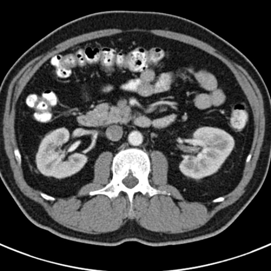 File:Bosniak cyst - type IV (Radiopaedia 23525-23627 renal cortical phase 27).jpg