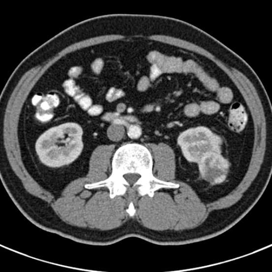 File:Bosniak cyst - type IV (Radiopaedia 23525-23627 renal cortical phase 36).jpg