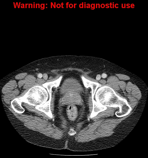 File:Bosniak renal cyst - type IV (Radiopaedia 23402-23466 D 79).jpg