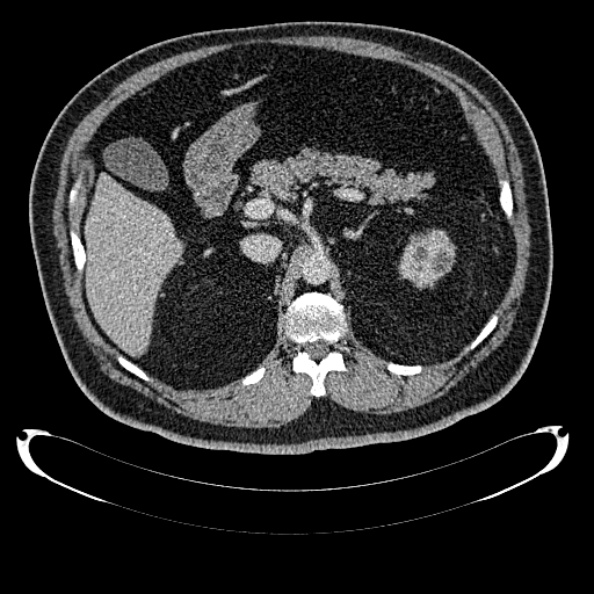 Bosniak renal cyst - type IV (Radiopaedia 24244-24518 C 104).jpg