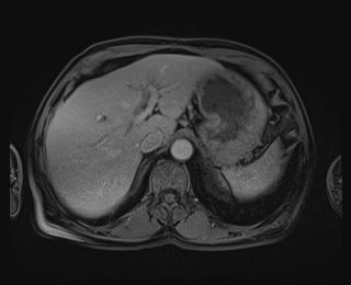 File:Bouveret syndrome (Radiopaedia 61017-68856 Axial T1 C+ fat sat 19).jpg