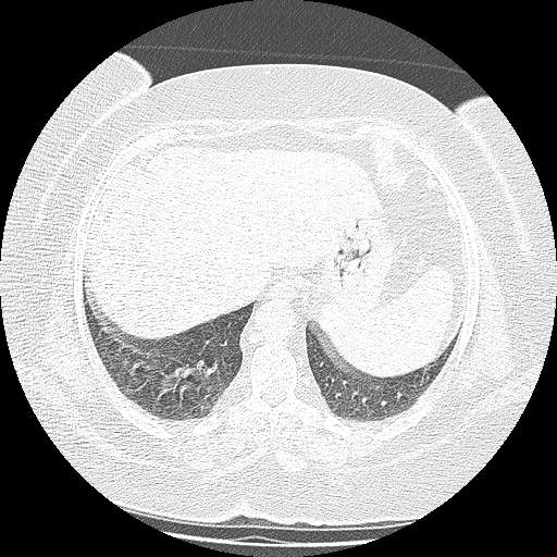 Bovine aortic arch - right internal mammary vein drains into the superior vena cava (Radiopaedia 63296-71875 Axial lung window 139).jpg