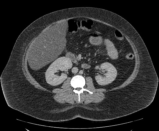 Bowel and splenic infarcts in acute lymphocytic leukemia (Radiopaedia 61055-68913 A 64).jpg