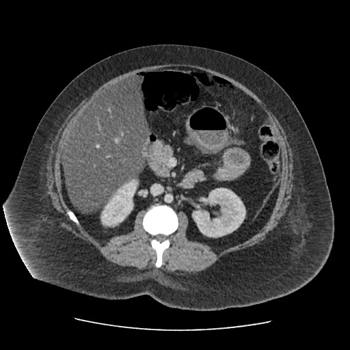 Bowel and splenic infarcts in acute lymphocytic leukemia (Radiopaedia 61055-68915 A 61).jpg