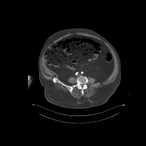 File:Bowel ischemia secondary to SMA occlusion with extensive portomesenteric venous gas (Radiopaedia 54656-60871 A 24).jpg