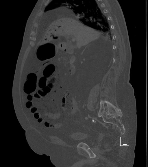 Bowel ischemia secondary to SMA occlusion with extensive portomesenteric venous gas (Radiopaedia 54656-60871 Sagittal bone window 68).jpg
