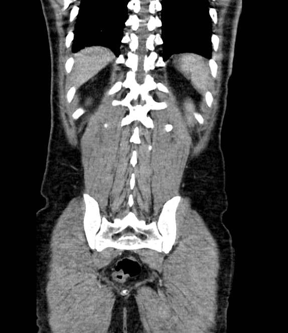 Bowel obstruction from colon carcinoma (Radiopaedia 22995-23028 C 63).jpg