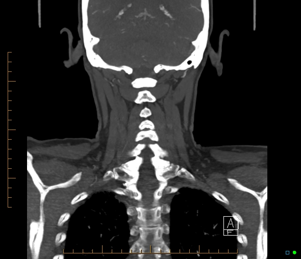 Brachiocephalic trunk stenosis (Radiopaedia 87242-103519 B 55).jpg