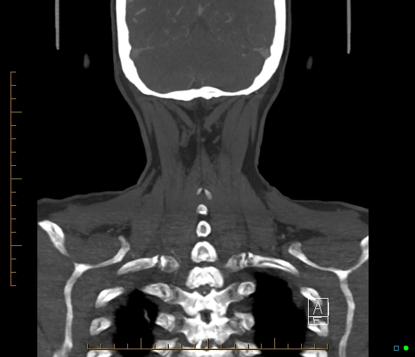 Brachiocephalic trunk stenosis (Radiopaedia 87242-103519 B 61).jpg