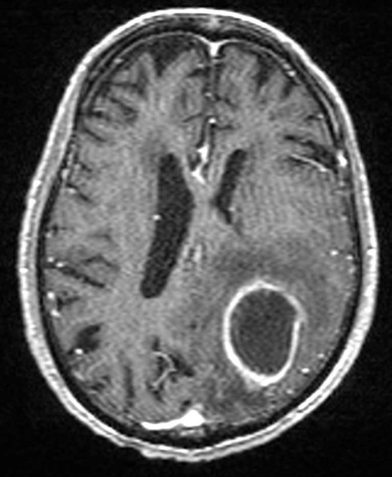Brain abscess with dual rim sign (Radiopaedia 87566-103938 Axial T1 C+ 105).jpg