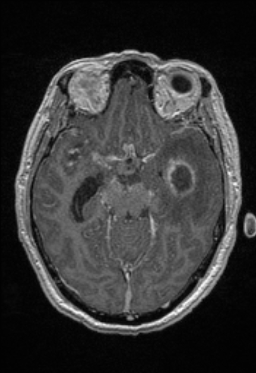 Brain abscess with ventriculitis (Radiopaedia 85703-101495 Axial T1 C+ 73).jpg
